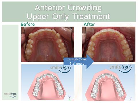 diagram showing the before and after effects of Smilelign braces on crowded teeth