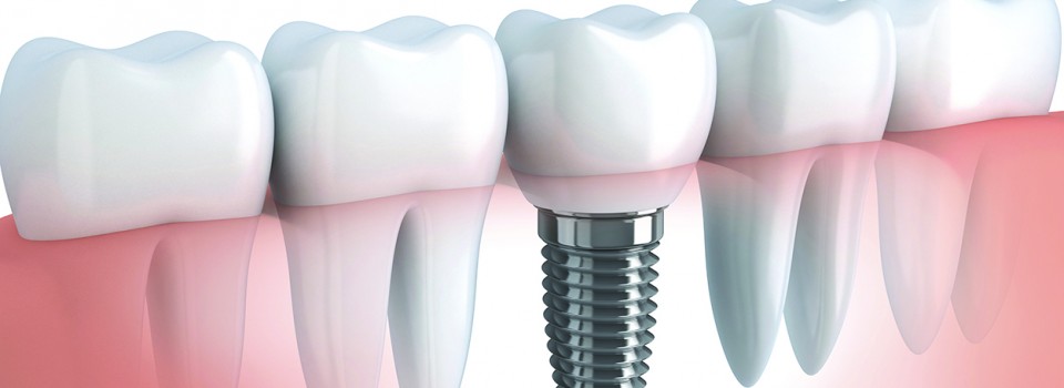 dental implants