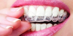 a woman fitting a clear plastic brace onto her top row of teeth