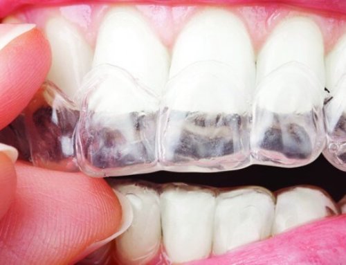 Why we love Smilelign Braces (and you should too!)