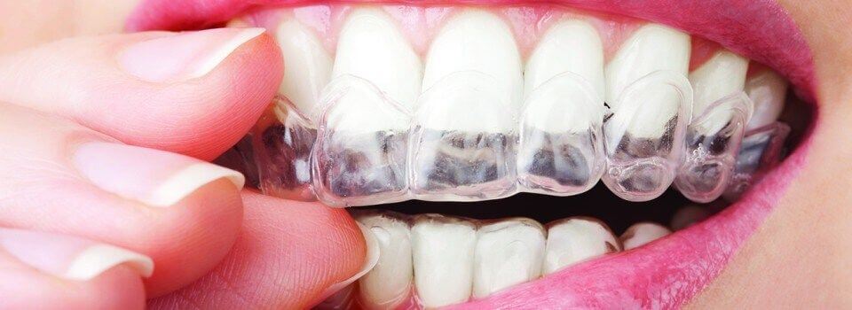a woman fitting a clear plastic brace onto her top row of teeth