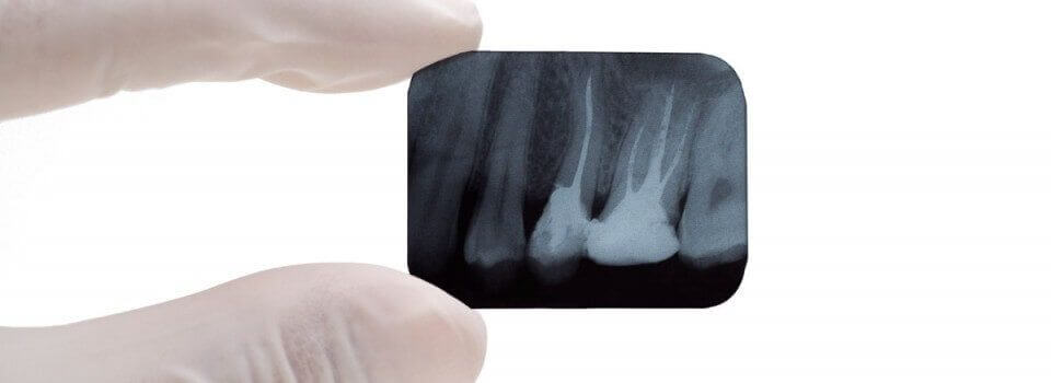 gloved fingers holding an x-ray of a tooth