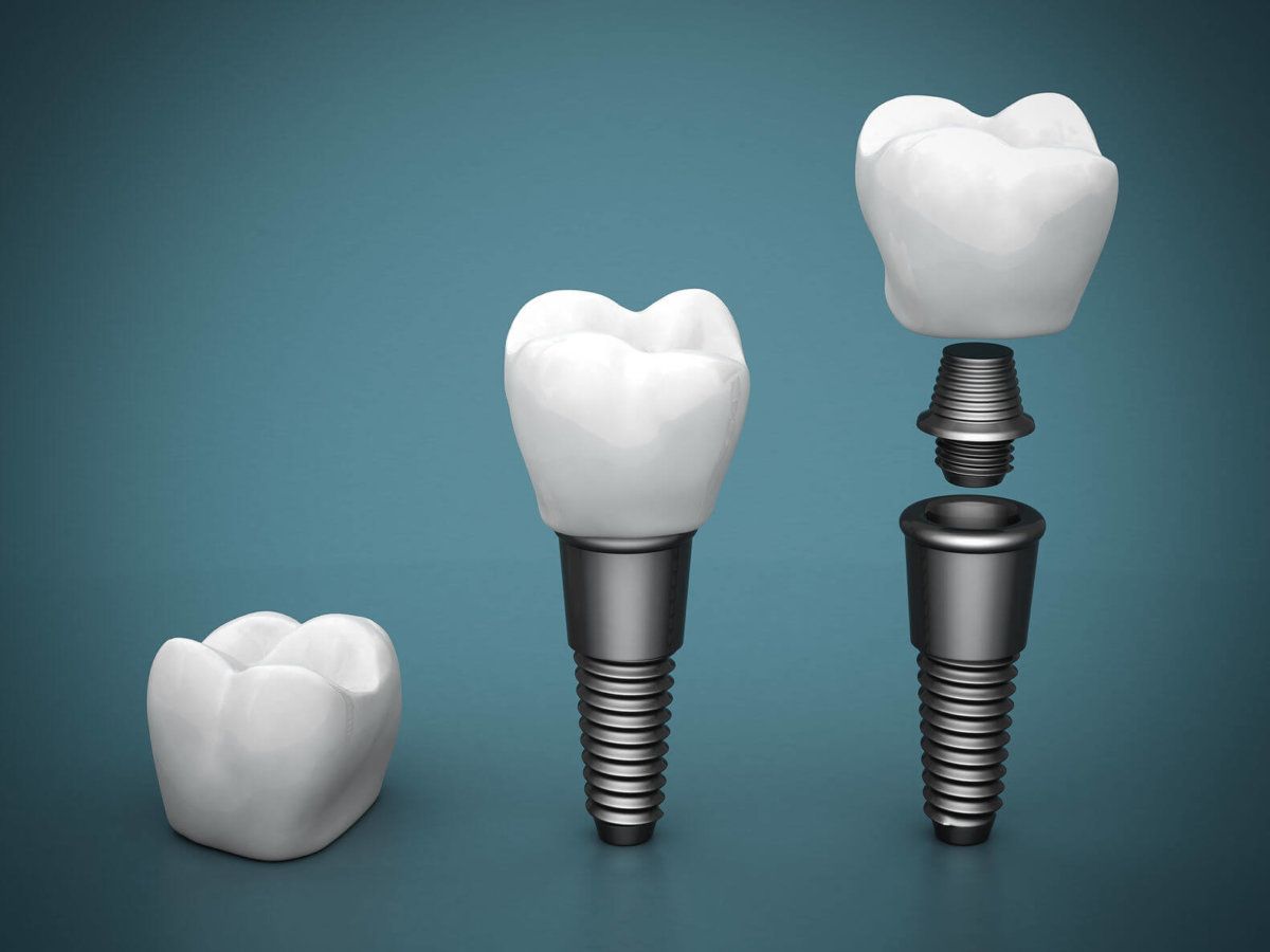 diagram showing the three stages of a tooth implant