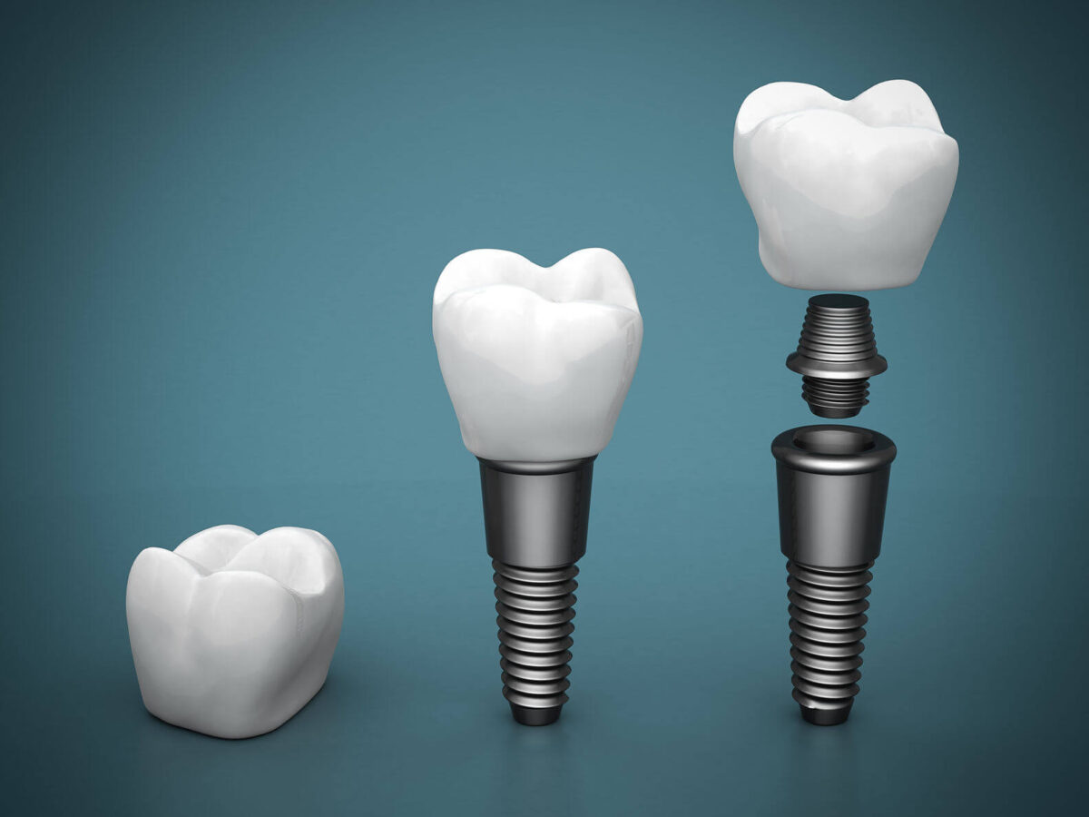 diagram showing the three stages of a tooth implant