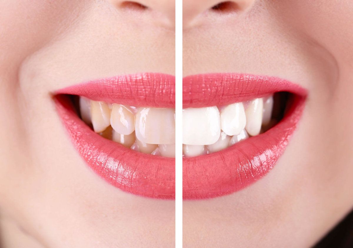 woman smiling to show her discoloured teeth before teeth whitening, and her bright white teeth after they have been whitened.