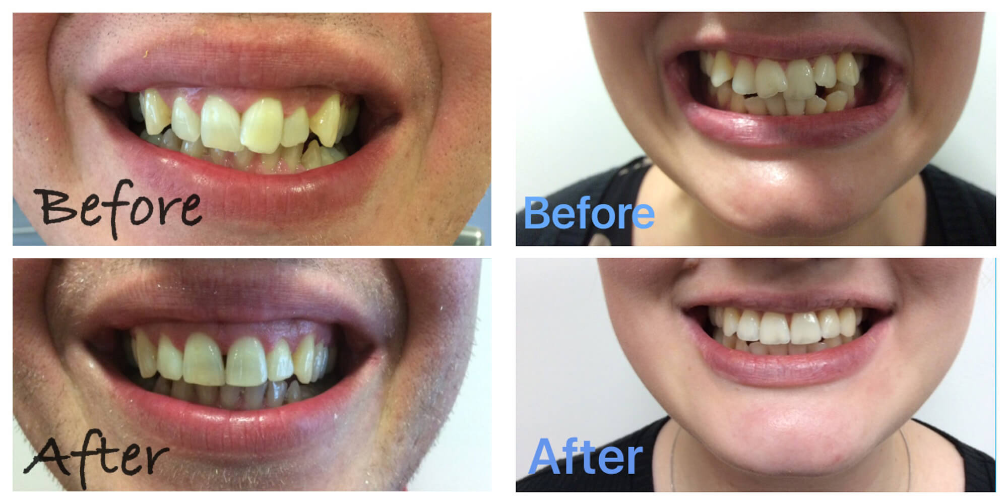 Invisible Braces, Teeth Straightening