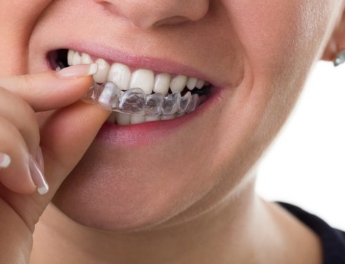 How do Braces Work?