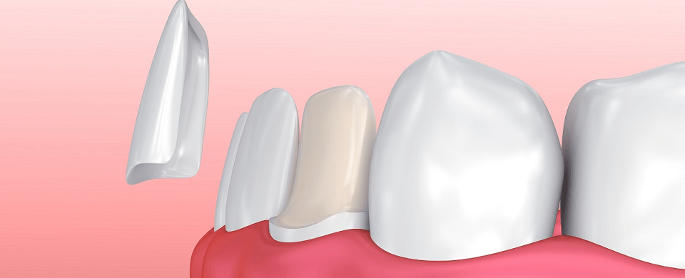 dental veneers