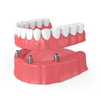 Implant supported dentures - bespoke denture clinic