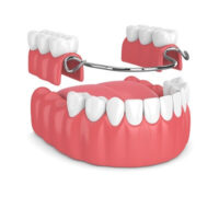 partial denture